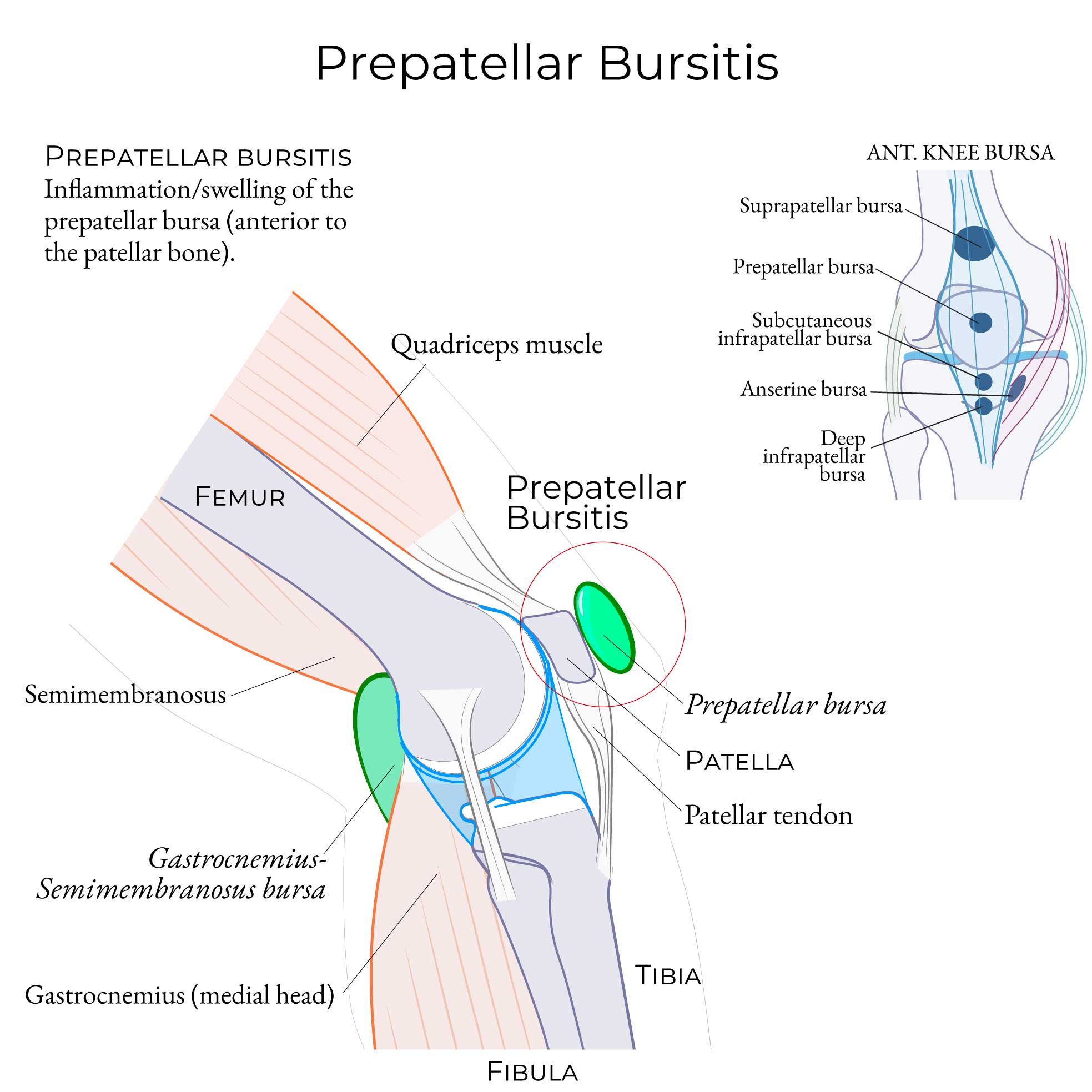 Prepatellar bursitis