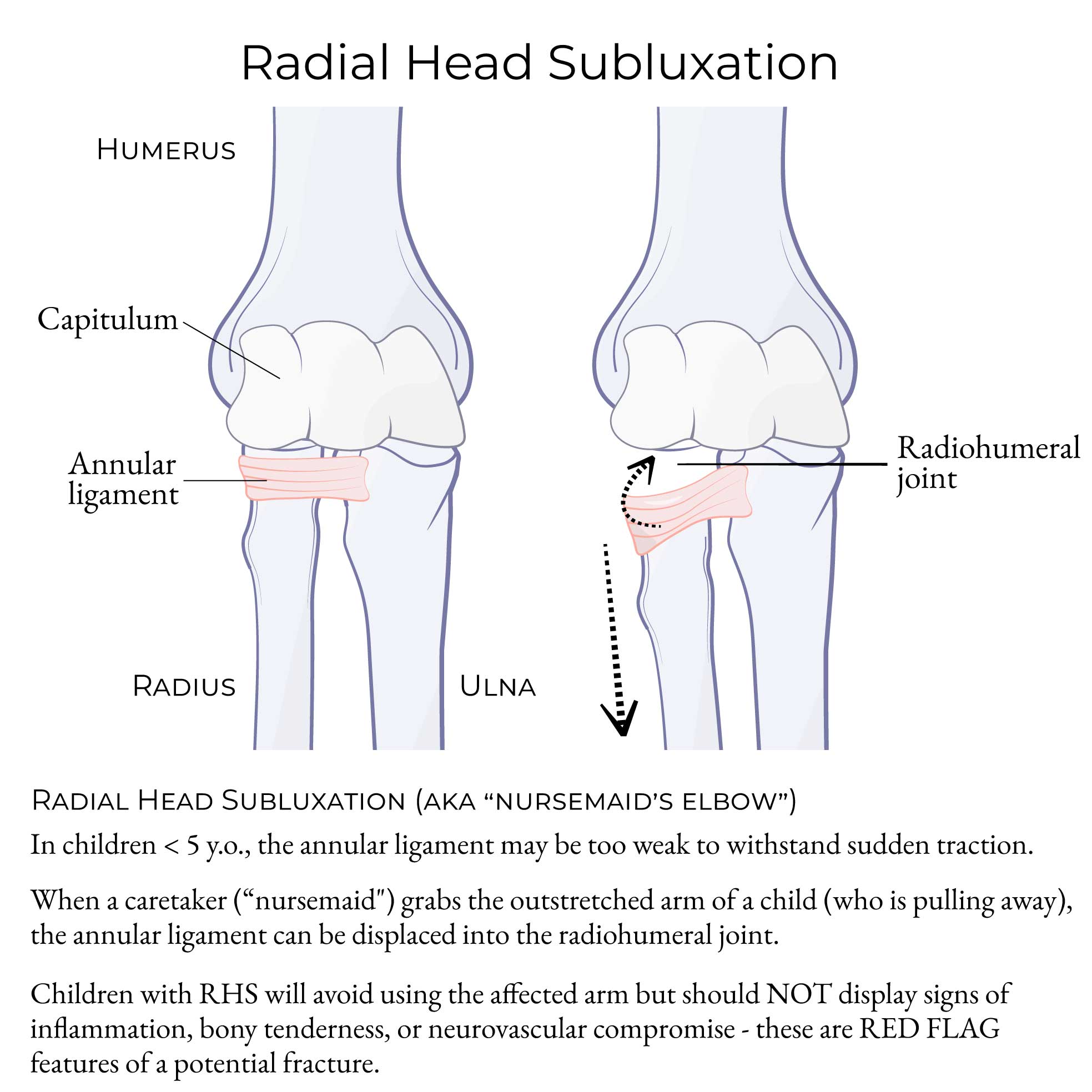 Radial Head Subluxation (aka, "Nursemaid's Elbow")