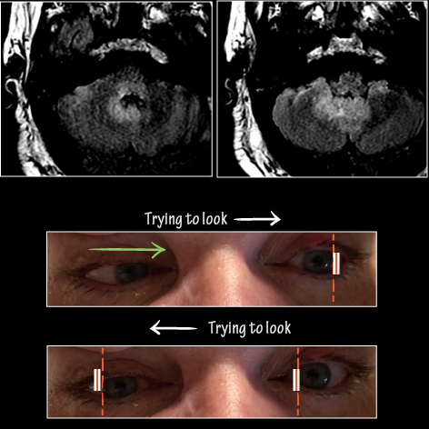 Rhombencephalitis (aka brainstem encephalitis)