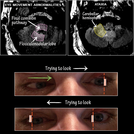 Rhombencephalitis (aka brainstem encephalitis)