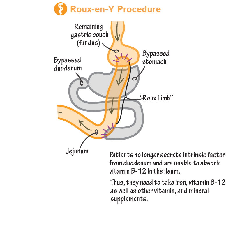 Roux-en-Y Procedure