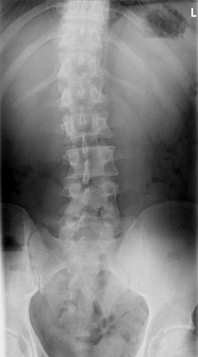 Scoliosis