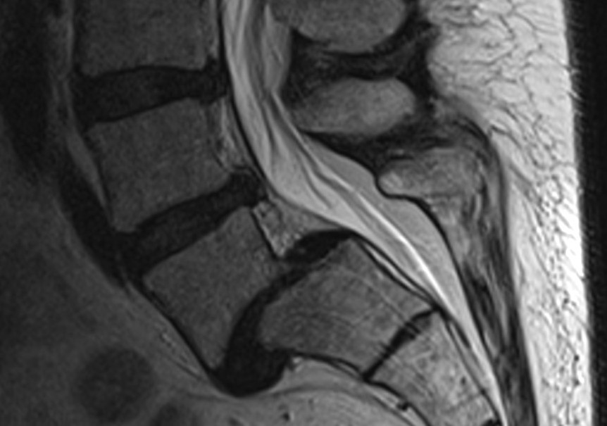 Spondylolisthesis