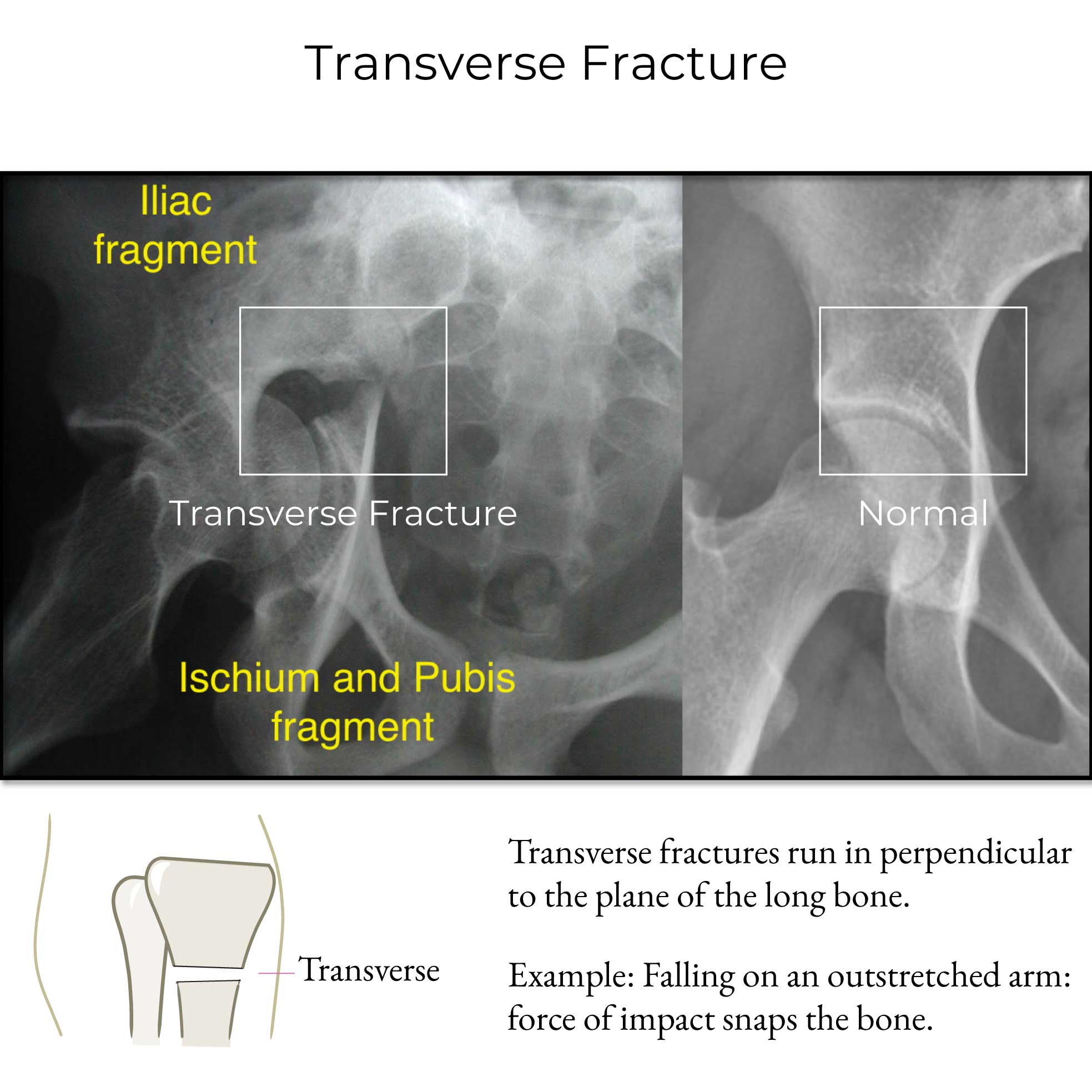 Transverse Fracture