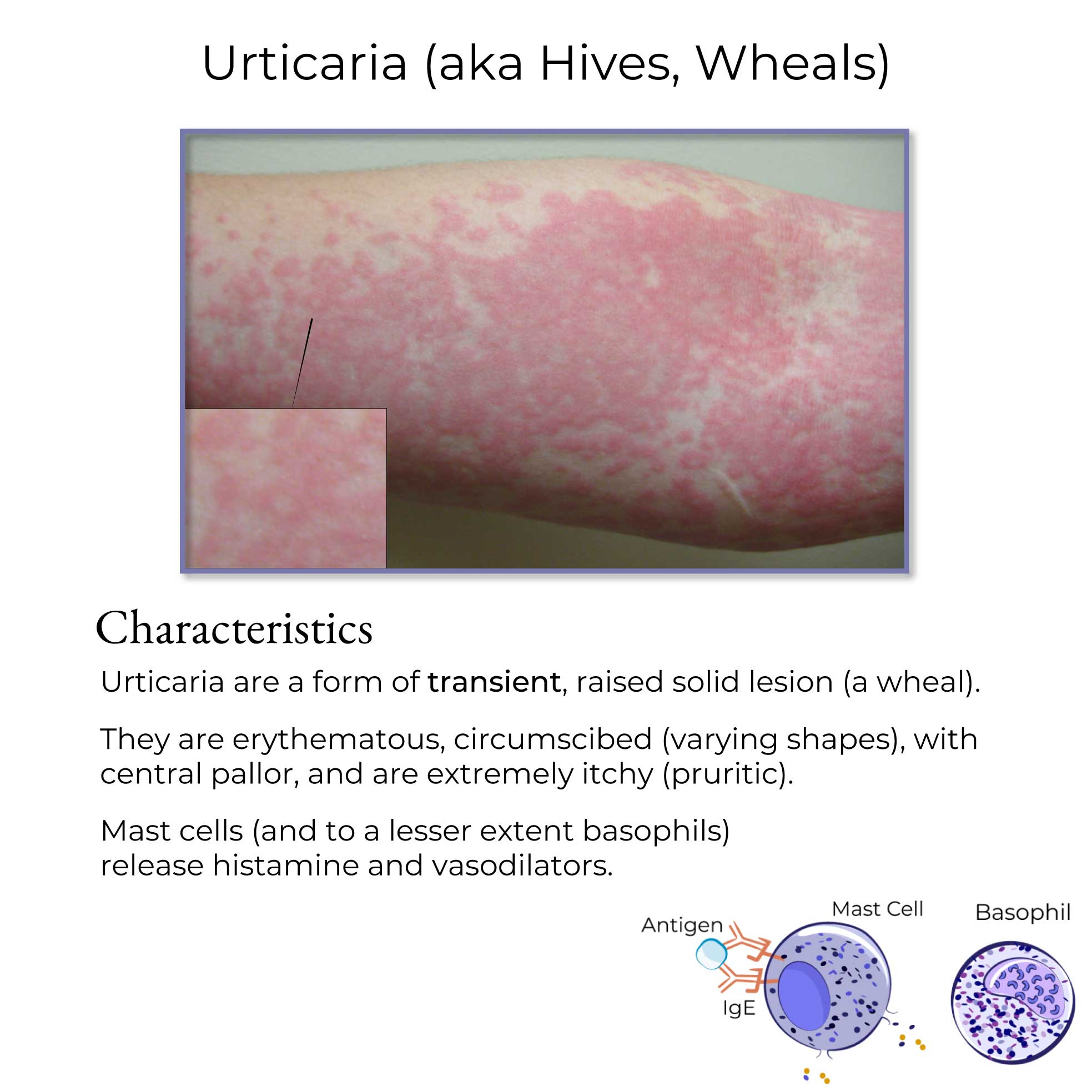 Clinical Pathology Glossary Urticaria Ditki Medical Biological Clinical Pathology Glossary Urticaria Ditki Medical Biological