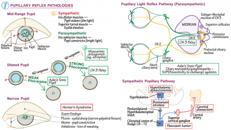 Clinical Pathology: Pupillary Reflex Pathologies | ditki medical ...