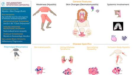 USMLE / COMLEX - Step 1: Dermatomyositis, Polymyositis, Polymyalgia ...